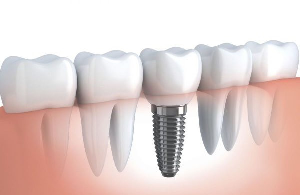 cấy ghép implant