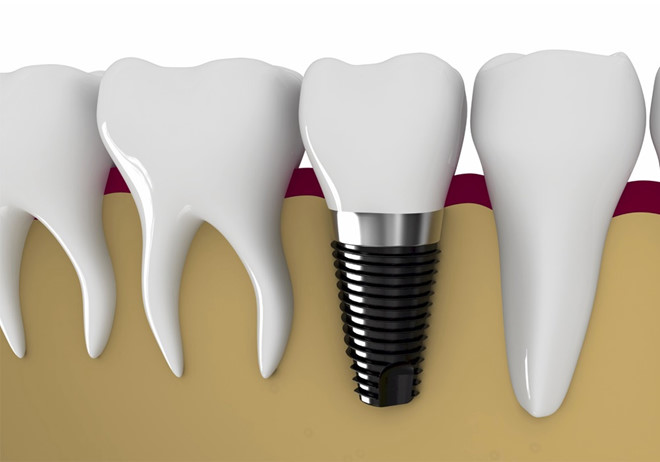 cấy ghép implant