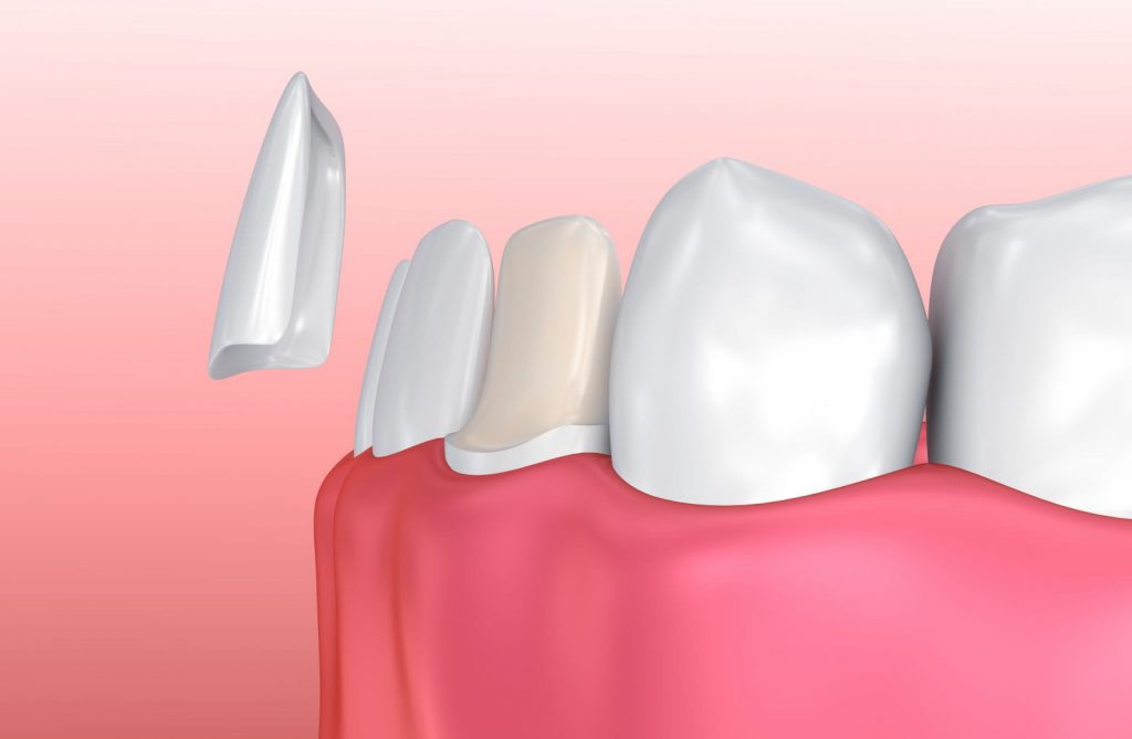 Dán sứ Veneer giá bao nhiêu