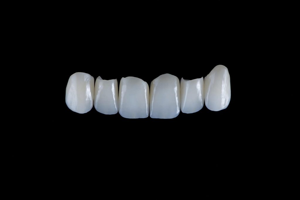 dán răng sứ veneer là gì