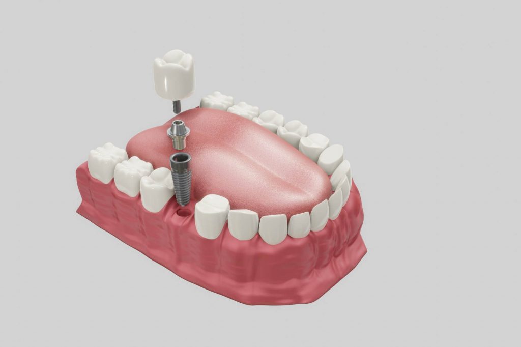 trồng răng implant giá bao nhiêu