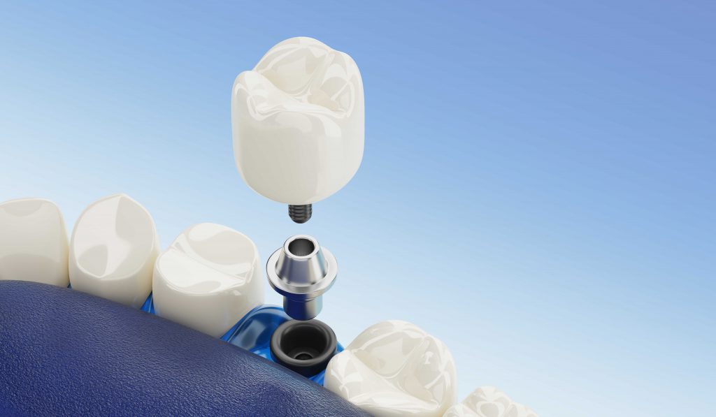 trồng răng implant mất bao lâu