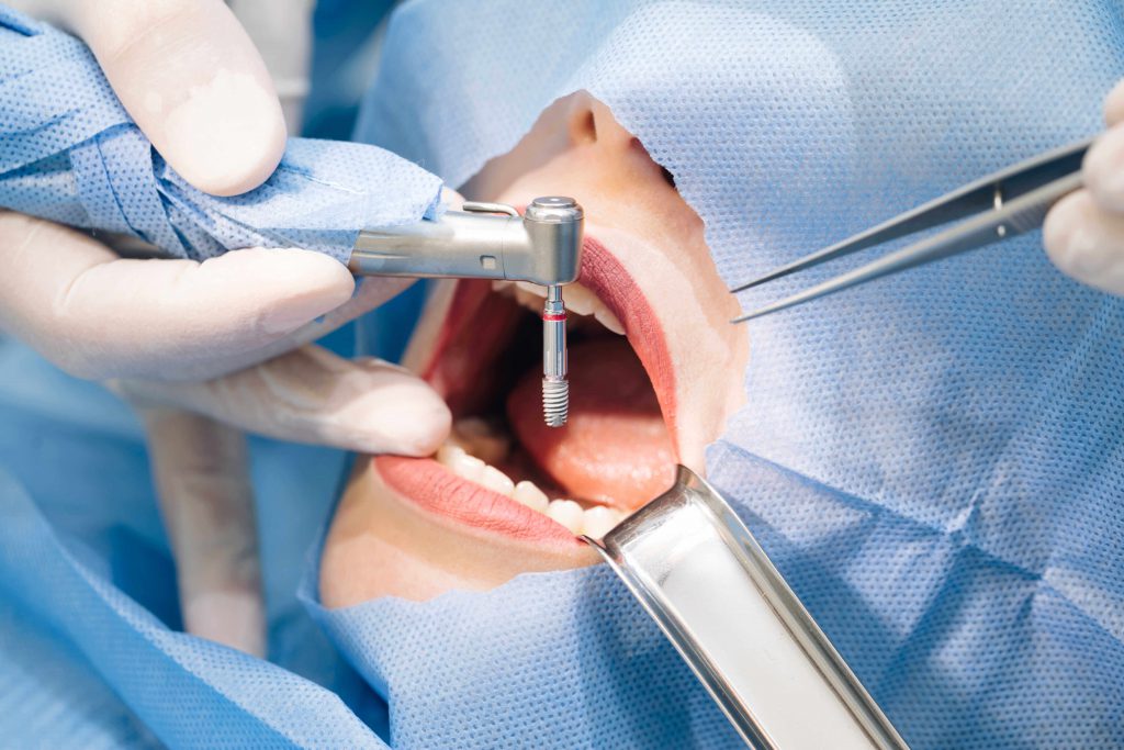 trồng răng implant có đau không
