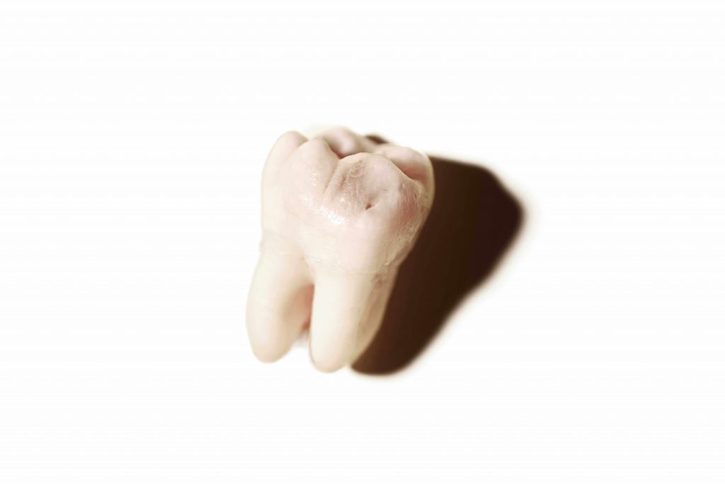 Viêm lợi trùm