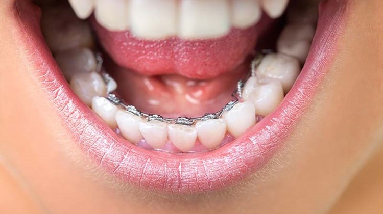niềng răng mặt trong