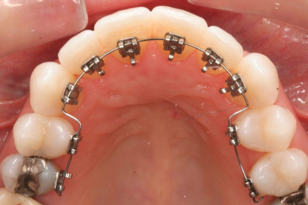 niềng răng mặt lưỡi