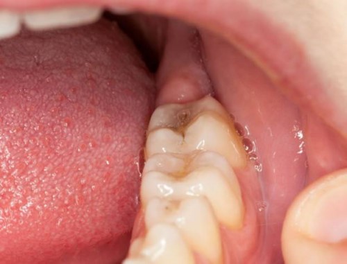 nhổ răng khôn có nguy hiểm không