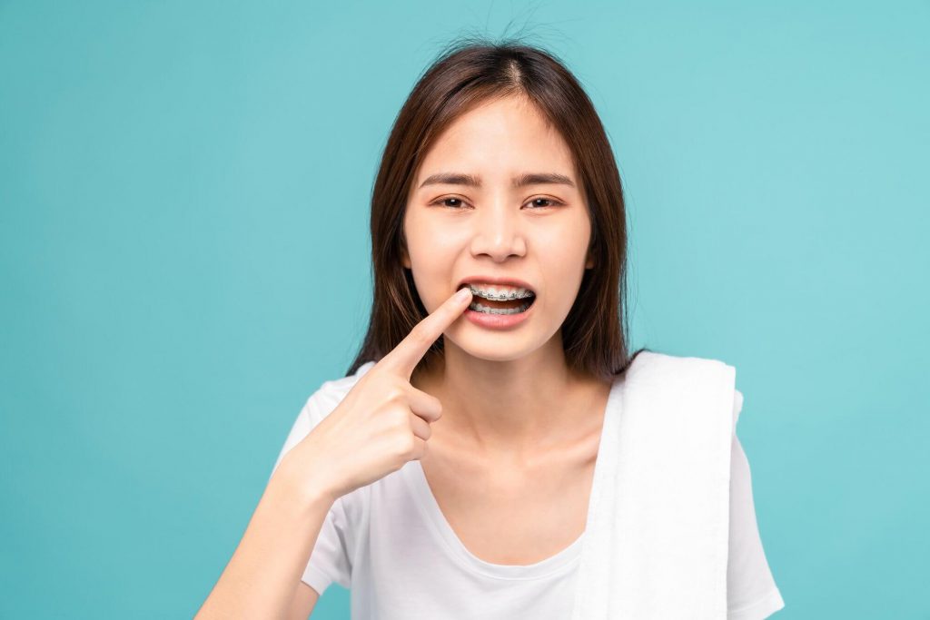 niềng răng hô